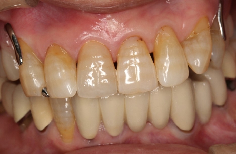 前歯部の審美的修復 | おおまえ歯科医院